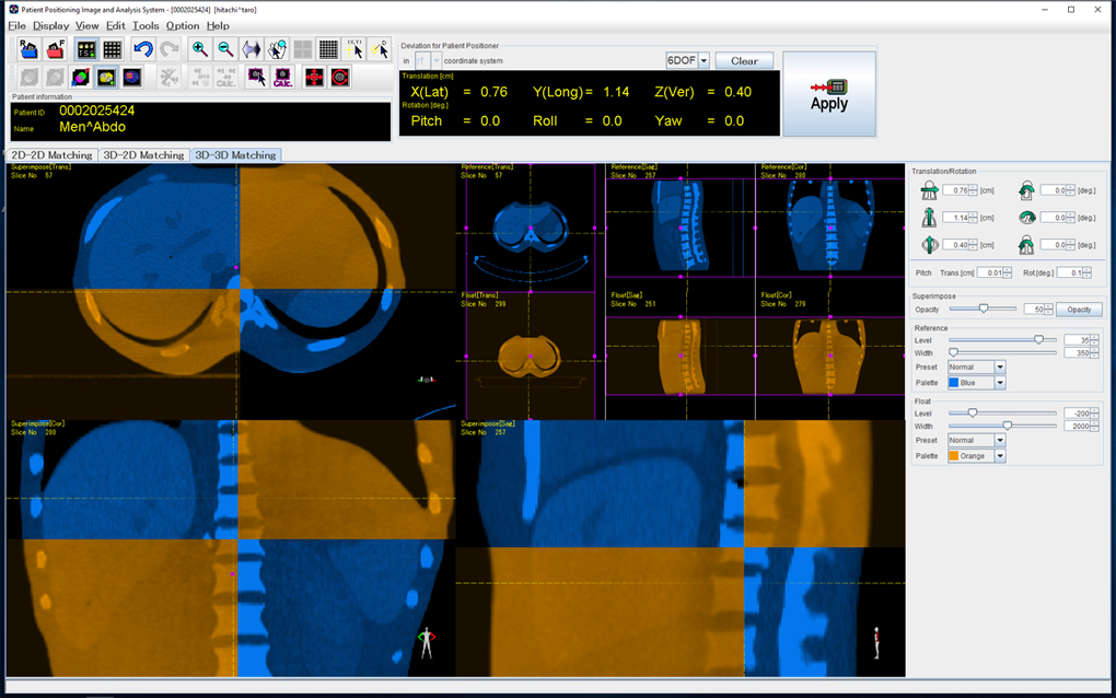 高精度なスポットスキャニング照射