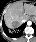 2.5 months after end of treatment