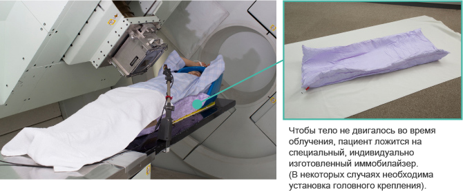 Чтобы тело не двигалось во время облучения, пациент ложится на специальный, индивидуально изготовленный иммобилайзер.(В некоторых случаях необходима установка головного крепления).