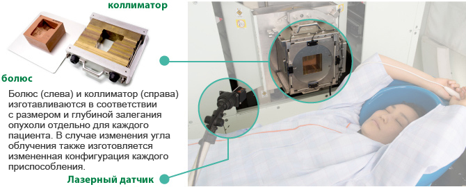 Болюс (слева) и коллиматор (справа) изготавливаются в соответствии с размером и глубиной залегания опухоли отдельно для каждого пациента. В случае изменения угла облучения также изготовляется измененная конфигурация каждого приспособления.